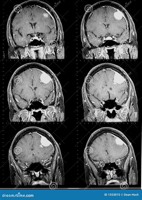 Mri Of Brain Showing Brain Tumor Royalty Free Stock Photo - Image: 1553015