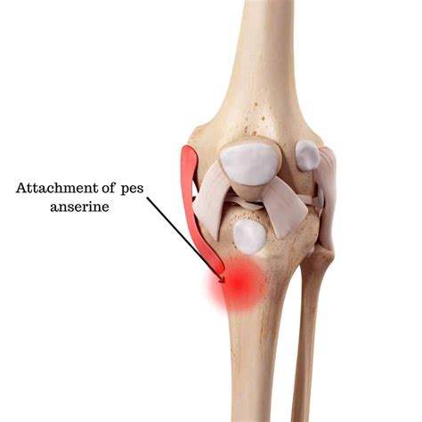 Pes Anserine Bursitis | FAQs