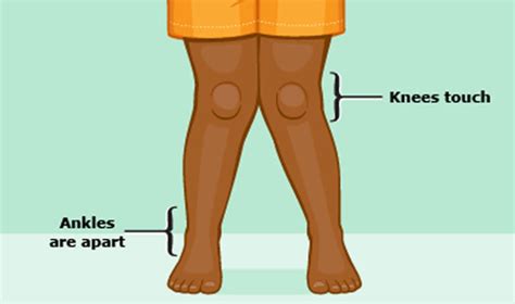 Genu valgum definition, causes, symptoms, diagnosis, treatment & prognosis