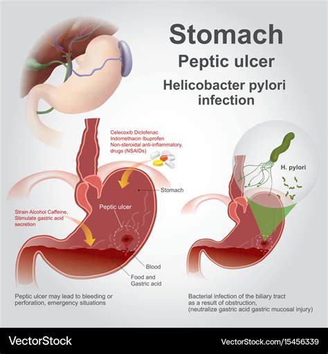 Stomach peptic ulcer charts Royalty Free Vector Image