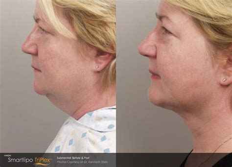 Smartlipo Triplex™ can target the jowls, neck, thighs, stomach, chest, and face. Carolina Laser ...