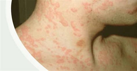 Aquagenic Pruritus (Allergy to Water): Major Causes, Symptoms, Treatment Options