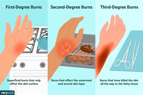 First Aid for Burns: 1st, 2nd, and 3rd Degree