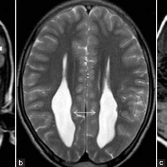 Hypothalamic hamartoma in a male child with central precocious puberty ...