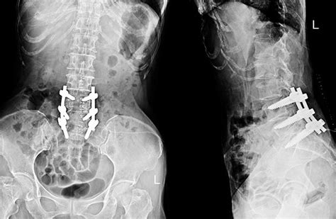 Post Laminectomy Syndrome - Causes & Treatments - Sound Pain Alliance