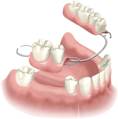 Full & Partial Dentures - Smiles by German Design