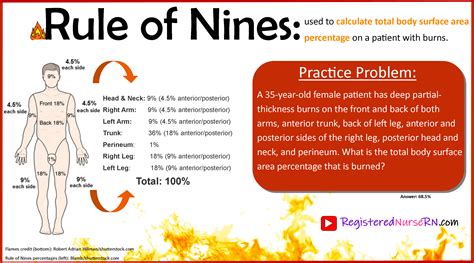 Rule Of Nines For Burns [Study Guide] – EZmed, 43% OFF