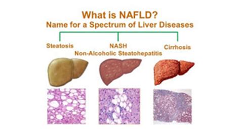 How Nash and fatty liver effects daily functioning of the liver