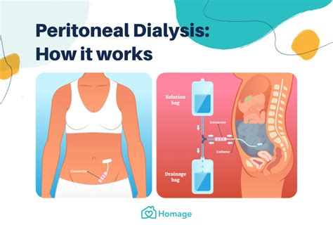 A Complete Guide to Peritoneal Dialysis in Singapore - Homage