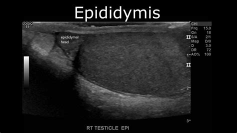 Testicular/Scrotal Doppler Protocol – Sonographic Tendencies