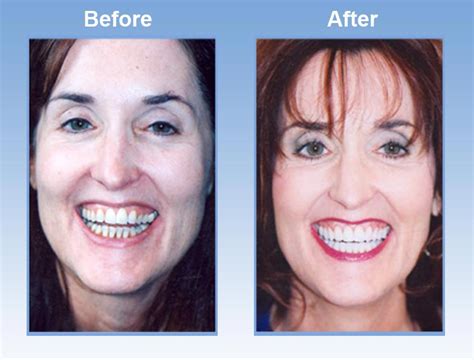 Cosmetic Dental Surgery Before And After - Dental News Network