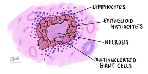 Inflammation granulomateuse nécrosante | MonRapportPathologie.ca