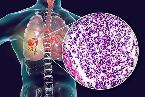 the new treatment for lung cancer? - Archyde