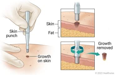 Punch biopsy | Cigna