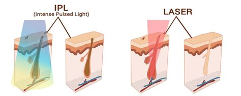 IPL Vs. Laser Hair Removal Reviews - Canova Medical