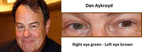 dan-aykroyd-complete-heterochromia-3