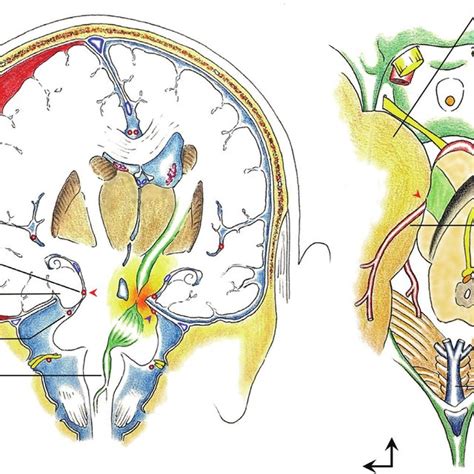 Artistic view of Kernohan-Woltman notch phenomenon caused by a... | Download Scientific Diagram