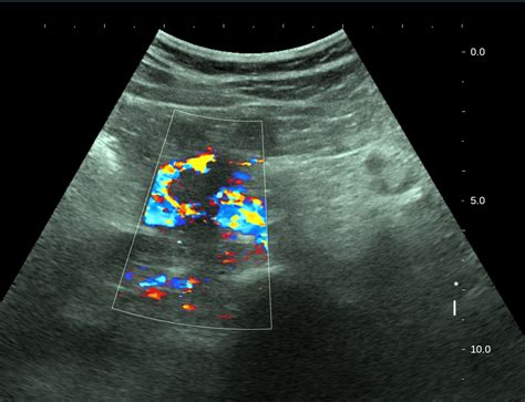 VIETNAMESE MEDIC ULTRASOUND: CASE 443: DUODENAL TUMOR, Dr PHAN THANH HẢI, Dr LÊ ĐÌNH TÍN, Dr ...