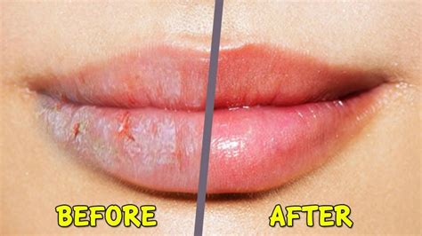 8 Homemade Remedies for Dry and Chapped Lips - Skin Care Top News