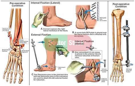 Right Ankle Fractures with Subsequent Surgical Fixation and Placement of an External Fixator ...