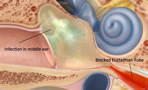 Ear Infections Treatment Los Angeles, CA