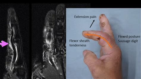 Kanavel's 4 Signs #MSK #Radiology #Orthopedics - YouTube