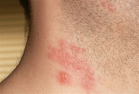 What Is the Main Cause of Shingles Rash? Signs, Symptoms, Vaccine