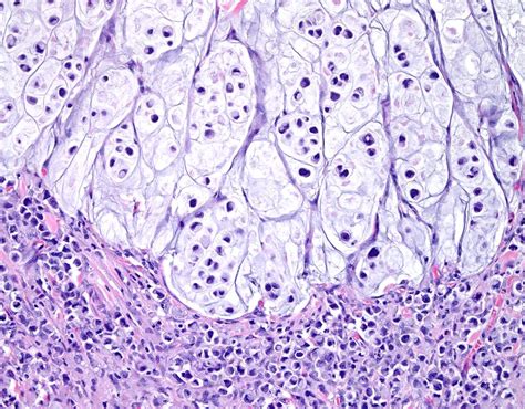 Signet ring cell carcinoma of the colon, light micrograph - Stock Image - C038/9597 - Science ...