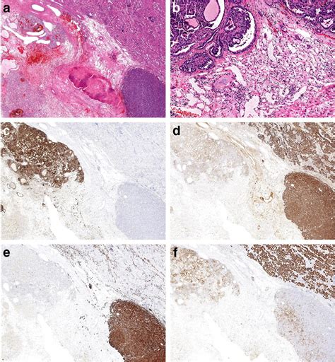 a A small focus of papillary RCC (lower right) within a clear cell RCC.... | Download Scientific ...