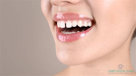 Can Tooth Gaps Be Fixed Without Braces? 4 Alt Options You'll Love