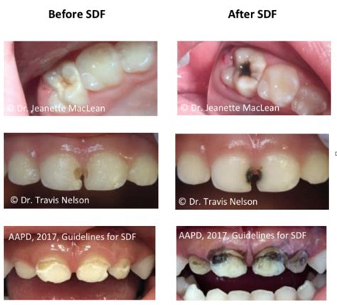 Silver Diamine Fluoride (SDF) - Gentle Dental