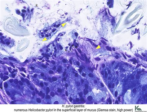 Pathology Outlines - Giemsa / Helicobacter pylori