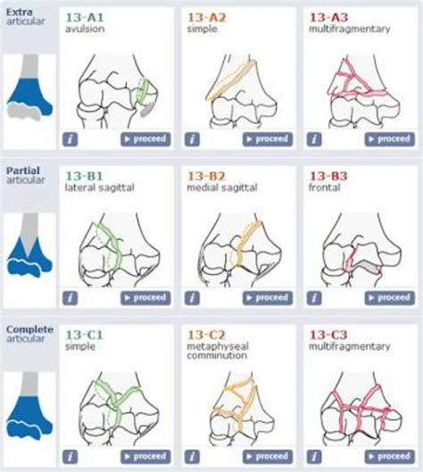 Humerus Supracondyler Fracture Classification