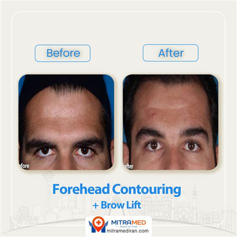 Forehead Contouring in Iran | Brow Bone Reduction | MITRAMED