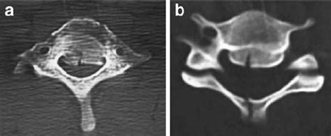 The retropulsion of bone a at the vertebral body level in a burst... | Download Scientific Diagram