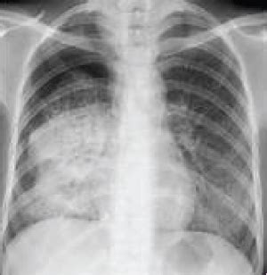 Tuberculosis Lung X Ray