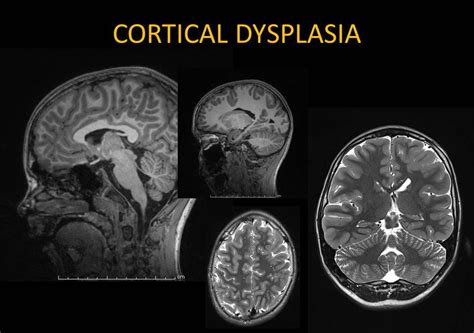 What Is Cortical Dysplasia? - EpilepsyU