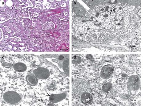 Figure 2 from Alteration of the pulmonary surfactant system in full-term infants with hereditary ...