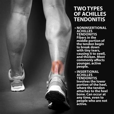 Can I Run With Achilles Tendonitis - Achilles Tendon Rupture Injury ...