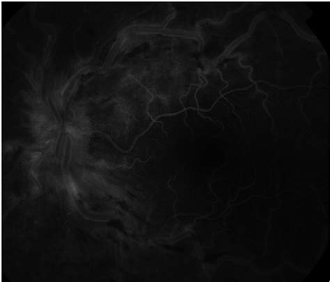 Fluorescein angiography of the left eye. | Download Scientific Diagram