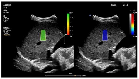 Diagnostics | Free Full-Text | Liver Ultrasound Elastography in Non ...