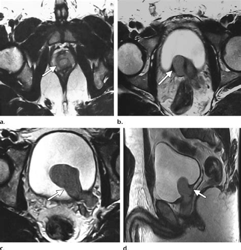 Ureterocele with hydroureter mimicking a prostatic cyst in a... | Download Scientific Diagram