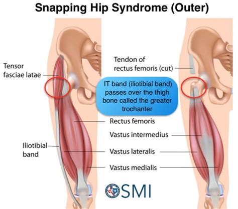 Snapping Hip Syndrome - The Orthopedic & Sports Medicine Institute in Fort Worth