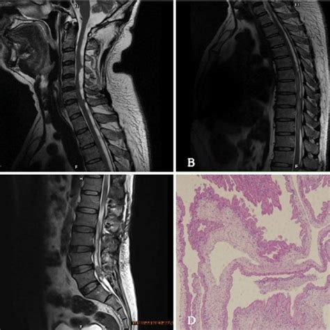 MRI of his spine showed that multiple cystic foci around the spinal ...