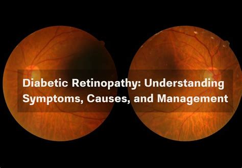 Don't Turn a Blind Eye: Understanding Diabetic Retinopathy