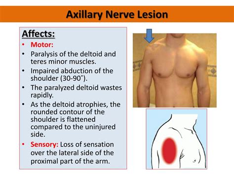 Axillary Nerve Injury Symptoms Causes And Treatment | My XXX Hot Girl