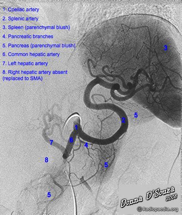 Splenic Artery Diagram