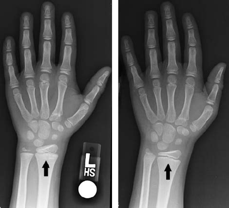 Hand/wrist radiograph of patient 1 at baseline (left) and after 24 ...
