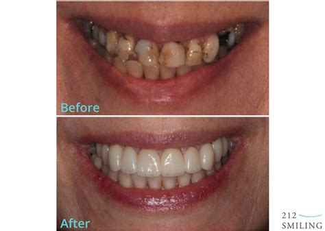 Female All Ceramic Crowns Before and After - 212 Smiling