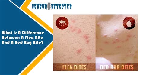 bed bugs vs fleas | Difference Between A Flea Bite And A Bed Bug Bite